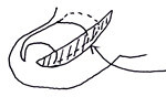 武蔵野市 巻き爪治療
